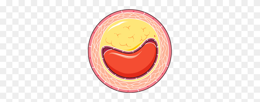 271x270 Atheroma - Blood Vessel Clipart