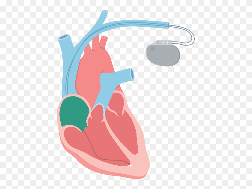 464x571 Bradycardia - Cardiologist Clipart