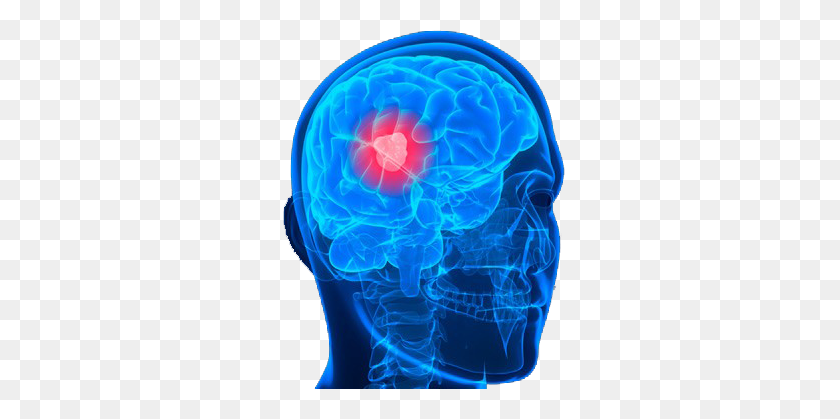 295x359 Brain Pasadena Cyberknife Center - Cerebro Humano Png