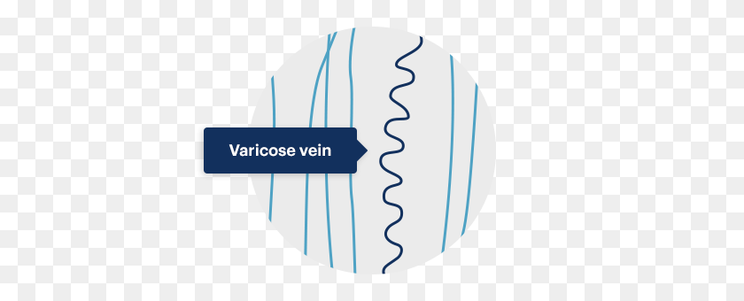 398x280 Causes Symptoms Of Leg Pain And Varicose Veins Due To Cvi Esenvia - Veins PNG
