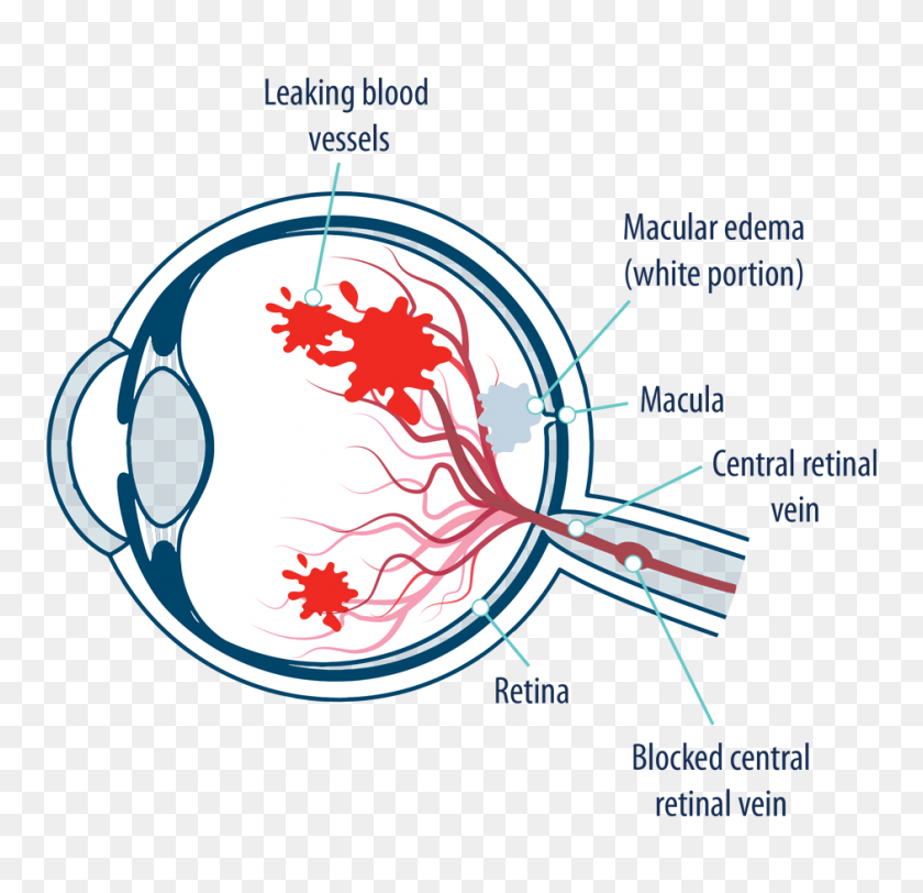 941x908 Eye With Macular Edema Following Retinal Vein Occlusion - Veins PNG