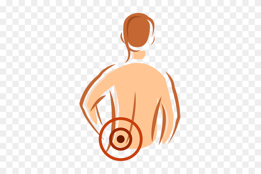 350x500 Low Back Pa Sciatica Bliss Acupuncture Clinic - Acupuncture Clipart