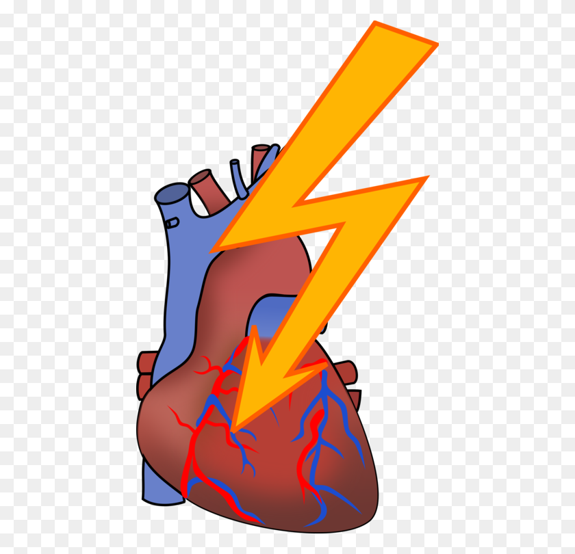 442x750 Infarto De Miocardio Arritmia Del Corazón Enfermedad Cardiovascular Libre - La Rabia De Imágenes Prediseñadas