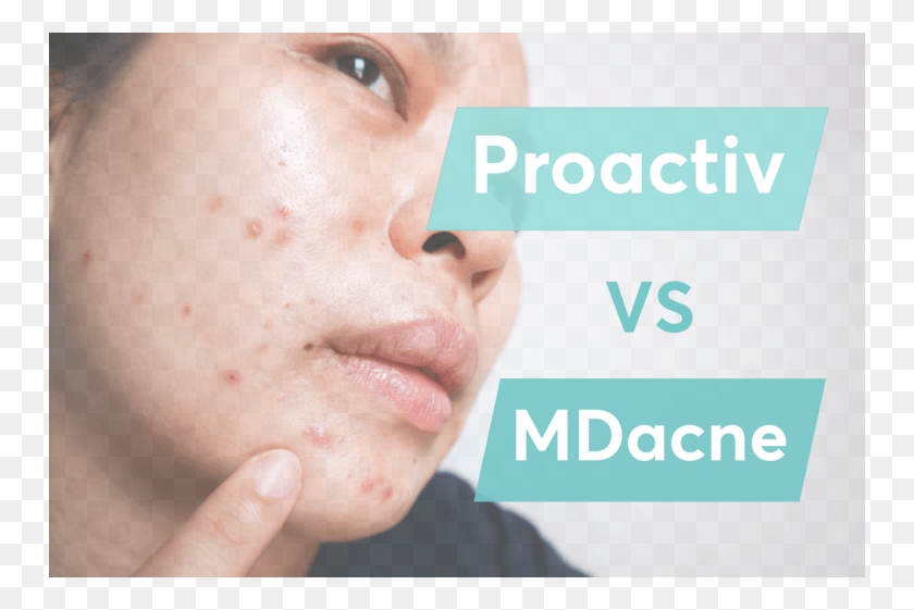 750x501 A Comparison Between Mdacne Proactivmd And Proactiv Close Up, Face, Person, Human HD PNG Download