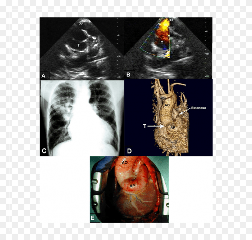 850x806 A Ecocardiograma Demonstrando Artria Pulmonar Emergindo Radiology, Collage, Poster, Advertisement HD PNG Download