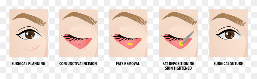 1074x276 A Eye Bag Removal Without External Scar, Teeth, Mouth, Lip HD PNG Download