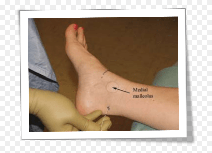 716x546 A Patient S Bare Foot And Ankle Can Be Seen Resting Toe, Person, Human, Arm HD PNG Download