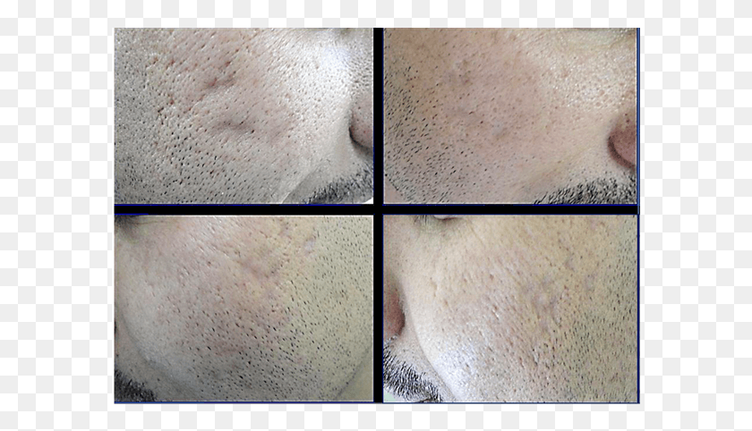 592x422 A Patient With Depressed Acne Scars Before And Six Freckle, Skin, Face, Collage HD PNG Download