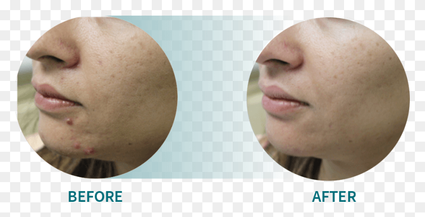 921x436 Active Acneacne Scars Freckle, Person, Human, Egg HD PNG Download