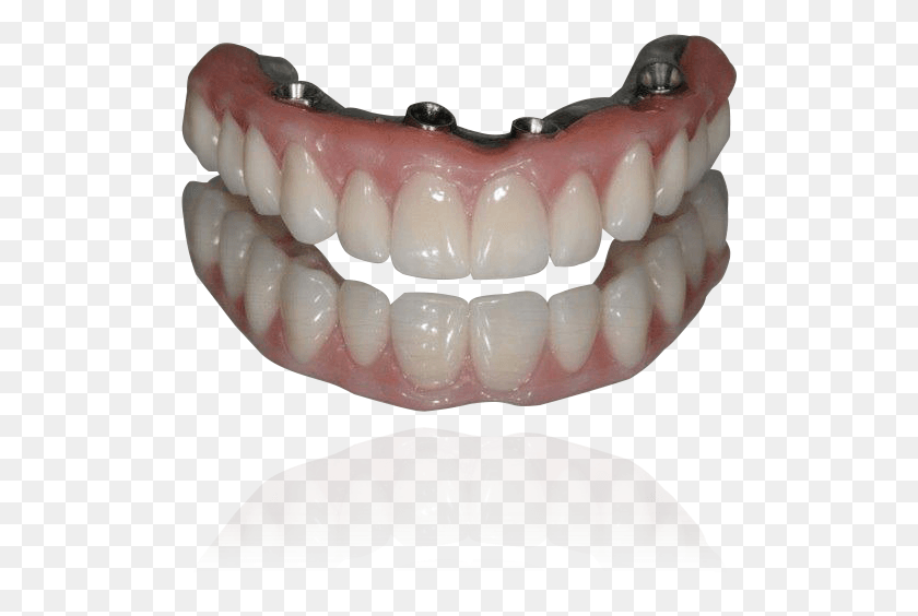 509x504 Все На 4 Зубных Имплантатах Implantes Dentarios All On, Челюсть, Зубы, Рот Png Скачать
