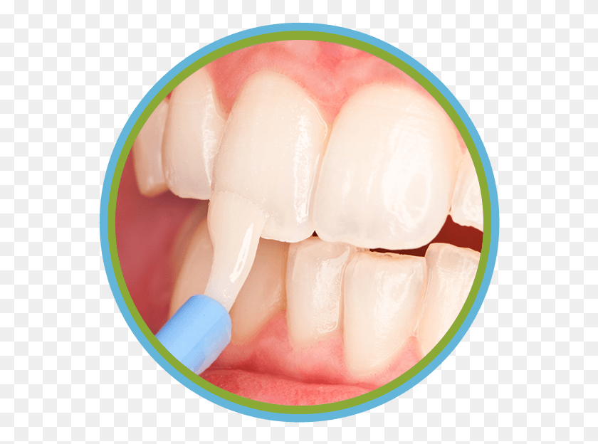 564x564 Alone Will Not Prevent Tooth Decay Fluoride Treatment, Teeth, Mouth, Lip HD PNG Download