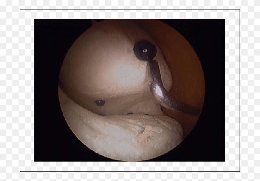 711x527 Arthroscopic View From Within The Simulator Of A Subject Cymbal, Animal, Invertebrate, Clam Descargar Hd Png