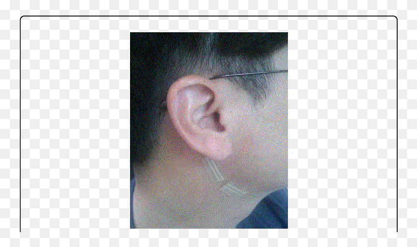 762x438 Attachment Of Half Piece Of Type A To The Digastric Ear, Person, Human, Skin HD PNG Download
