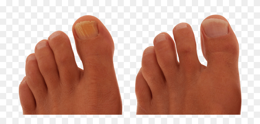 722x340 Before After Feet Toe, Person, Human HD PNG Download
