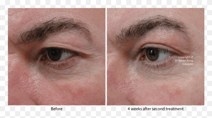 828x433 Before After Plexr Results, Skin, Face, Person HD PNG Download
