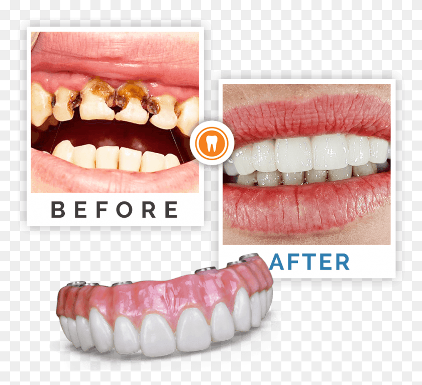 938x851 До И После Стоматологической Процедуры Rotte Tanden Kinderen, Зубы, Рот, Губа Png Скачать