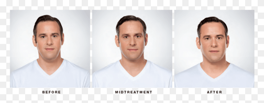 1003x345 Before And After Deoxycholic Acid, Person, Human, Face HD PNG Download