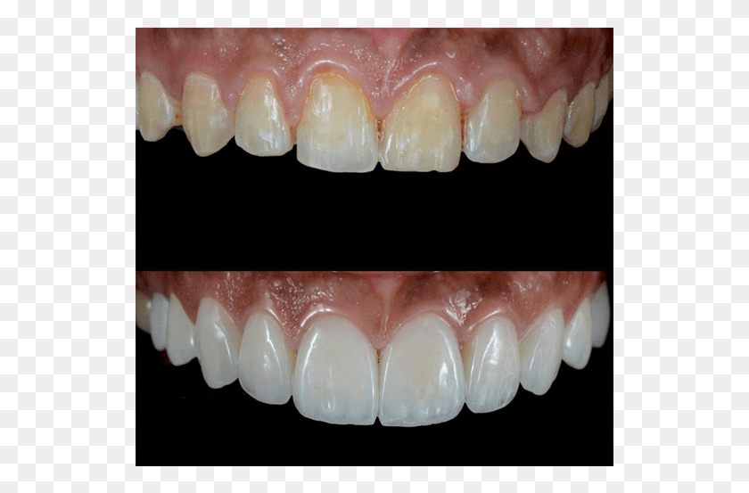 537x493 До И После Белых Зубов Стоматологические Винири, Рот, Губа, Челюсть Png Скачать