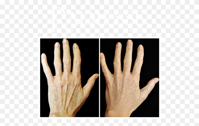 520x473 Descargar Png / Antes Y Después Del Tratamiento Con Radiesse Hands Radiesse Hands, Persona, Humano, Mano Hd Png