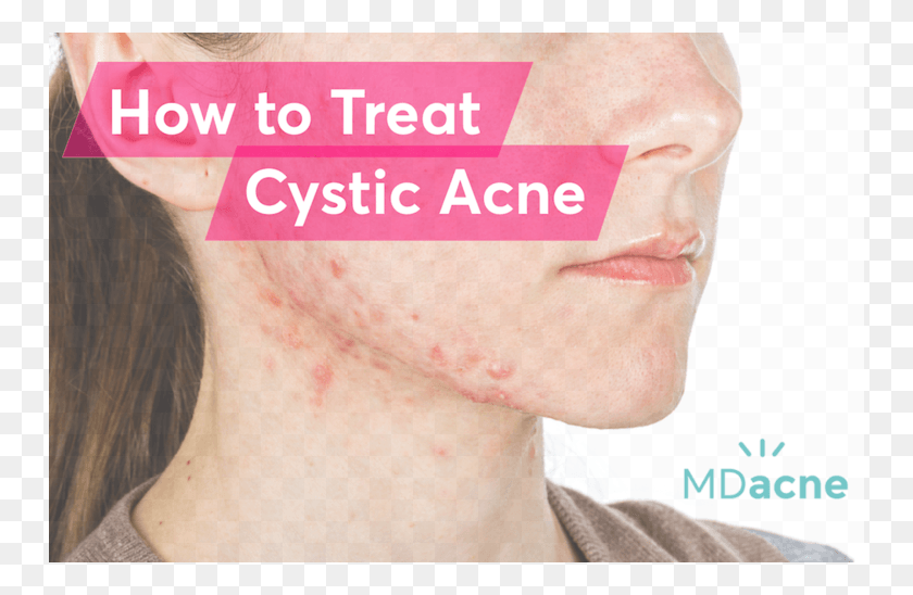 750x488 Blog Header Image For How To Treat Cystic Acne Poster, Face, Person, Human HD PNG Download