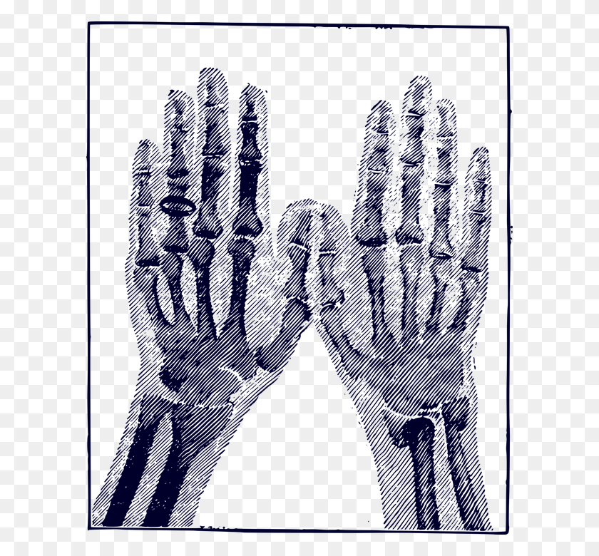 598x720 Bones Hand Image Medical Medicine Picture Ring X Ray Hand Vector Free Illustrator, Clothing, Apparel, Text HD PNG Download