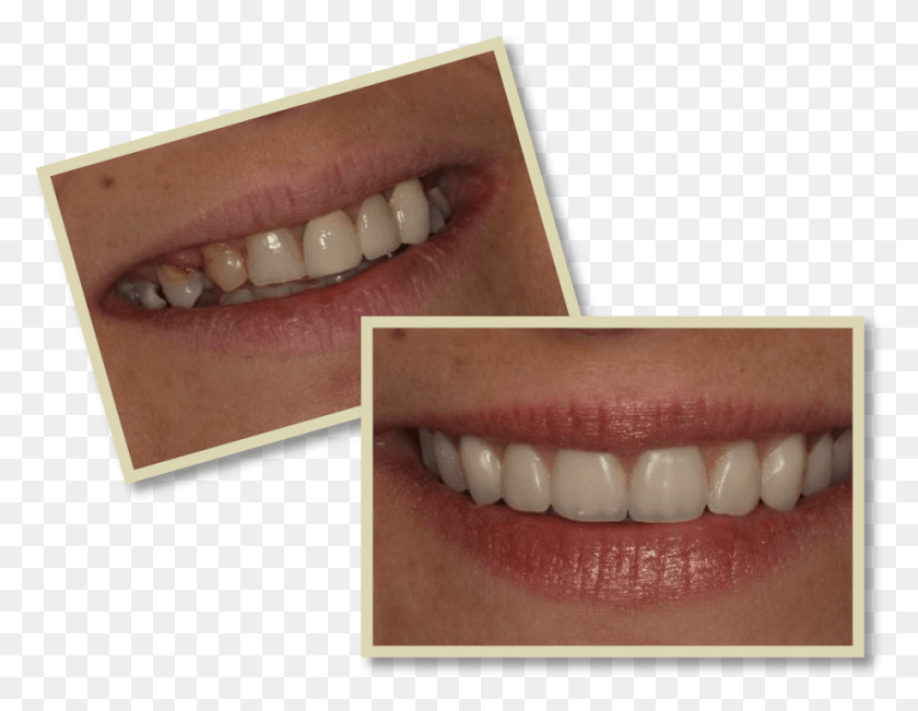 922x699 Бонни До И После Отбеливания Зубов, Зубы, Рот, Губа Hd Png Скачать