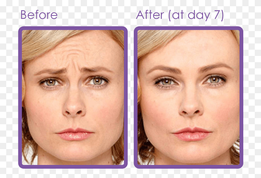726x513 Botox, Face, Person, Human HD PNG Download