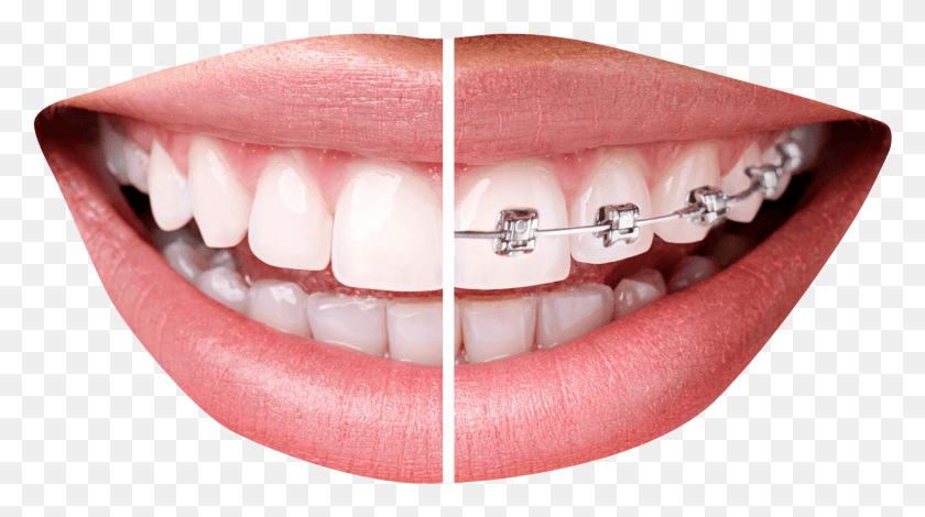 1903x1001 Braces, Teeth, Mouth, Lip HD PNG Download