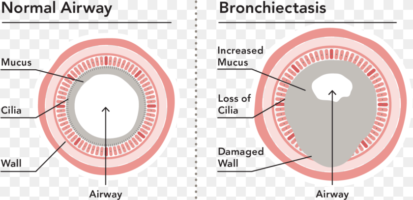 Bronchiectasis Loss Of Cilia Clipart PNG