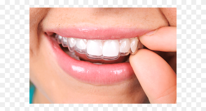 601x396 Bruxismo Placa Smile Direct Impressions Kit, Teeth, Mouth, Lip HD PNG Download