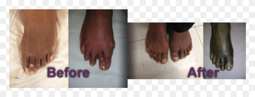 1111x371 Bunion Case Barefoot, Toe, Person, Human HD PNG Download