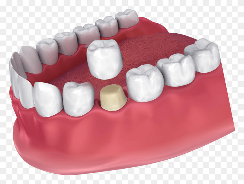 1108x818 Png Изображение - Причины Поврежденных Зубных Коронок.