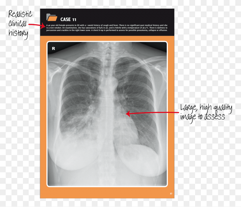 1200x1018 Chest X Ray Example Radiography, X-ray, Ct Scan, Medical Imaging X-ray Film HD PNG Download