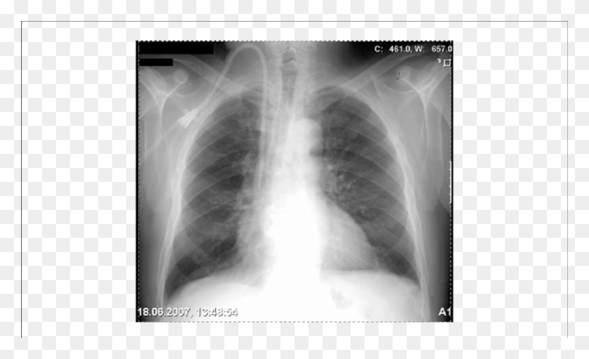 850x494 Chest X Ray Of A Patient With A Tunnelled Right Internal Right Internal Jugular Catheter, X-ray, Medical Imaging X-ray Film, Ct Scan HD PNG Download
