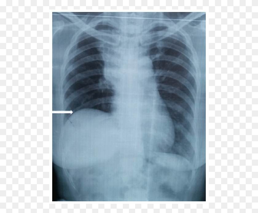 521x634 Chest X Ray Showing Elevated Right Hemi Diaphragm And Elevated Right Hemidiaphragm X Ray, X-ray, Ct Scan, Medical Imaging X-ray Film HD PNG Download