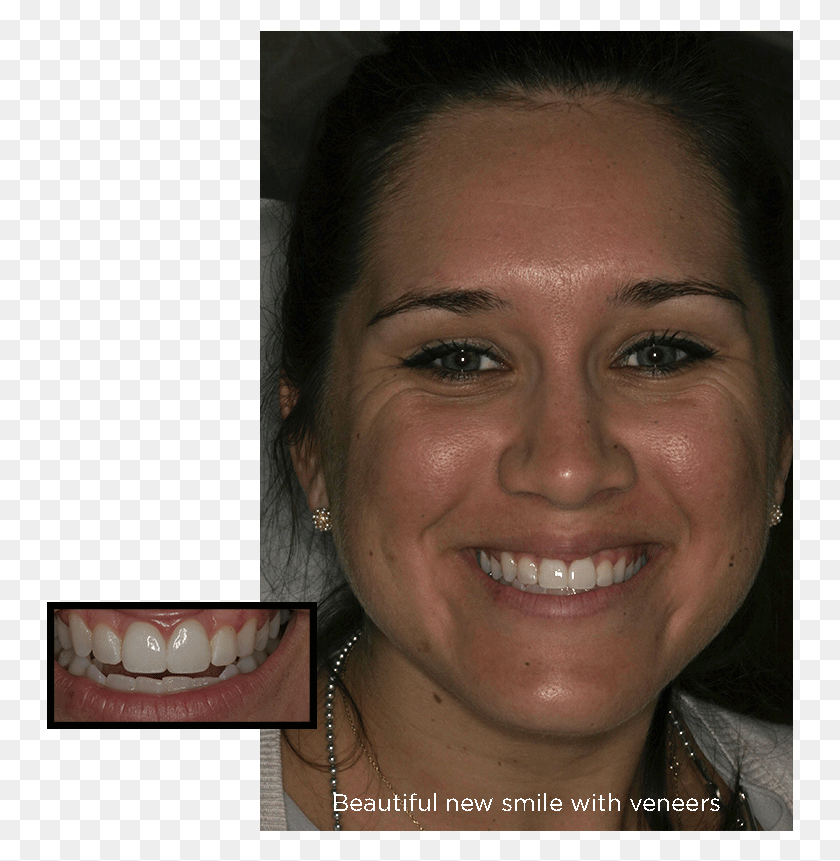 747x801 Chipped Front Teeth After Porcelain Veneers Treatments Girl, Mouth, Lip, Jaw HD PNG Download