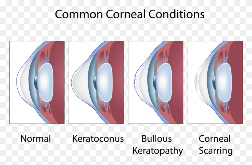1131x711 Click To Enlarge Abnormal Shape Of The Cornea Or Lens, Egg, Food, Electronics HD PNG Download