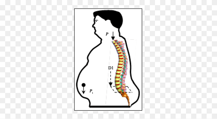 267x401 Constitution Spine At The Disc Depending On Its Condition Obesity Effect On Spine, Plot, Diagram, Text HD PNG Download