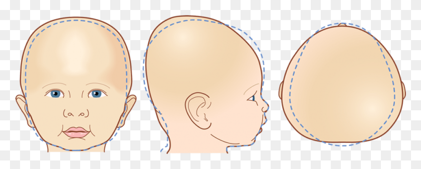 1030x366 Cranial Head Shapes Brachycephaly Forehead, Person, Human, Ear HD PNG Download