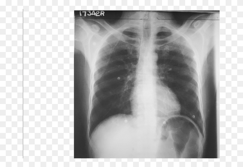 683x518 Cxr Pa Showing Distended Stomach X Ray, X-ray, Medical Imaging X-ray Film, Ct Scan HD PNG Download