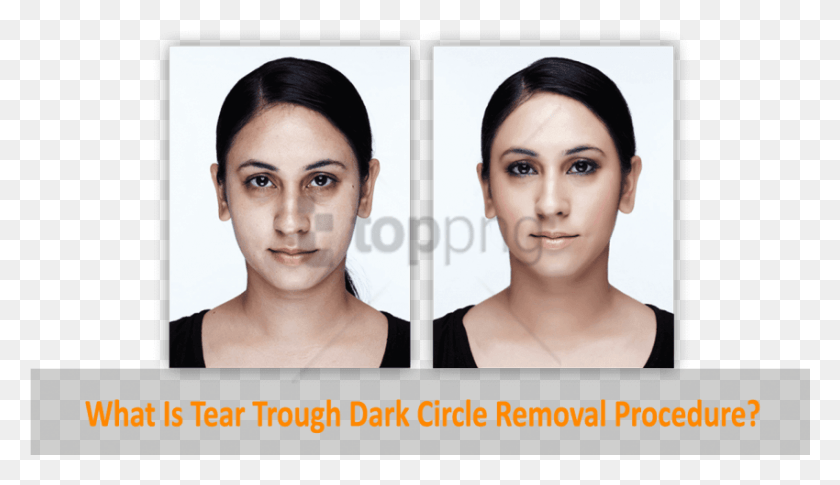 850x464 Dark Circle Eye Roller Before And After Image With Dermisa Brightening Cream Before, Face, Person, Human HD PNG Download