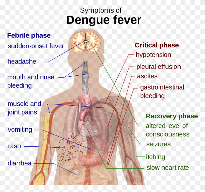 959x894 Dengue Fever Symptoms Dengue Retro Orbital Pain, Person, Human, Plot Descargar Hd Png