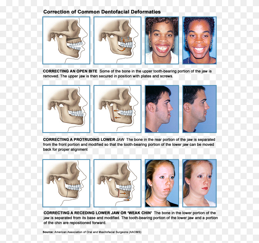 573x727 Dentofacial Orthodontic Surgery Coquitlam Bc Jaw Correction Braces, Person, Human, Collage HD PNG Download