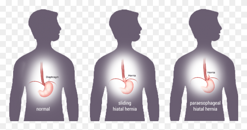 955x469 Depiction Of Normal Stomach Completely Below Diaphragm Illustration, Hand, Arm, Person HD PNG Download