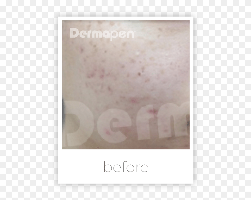 502x608 Dermapen For Acne Scars Poster, Skin, Face, Rug HD PNG Download