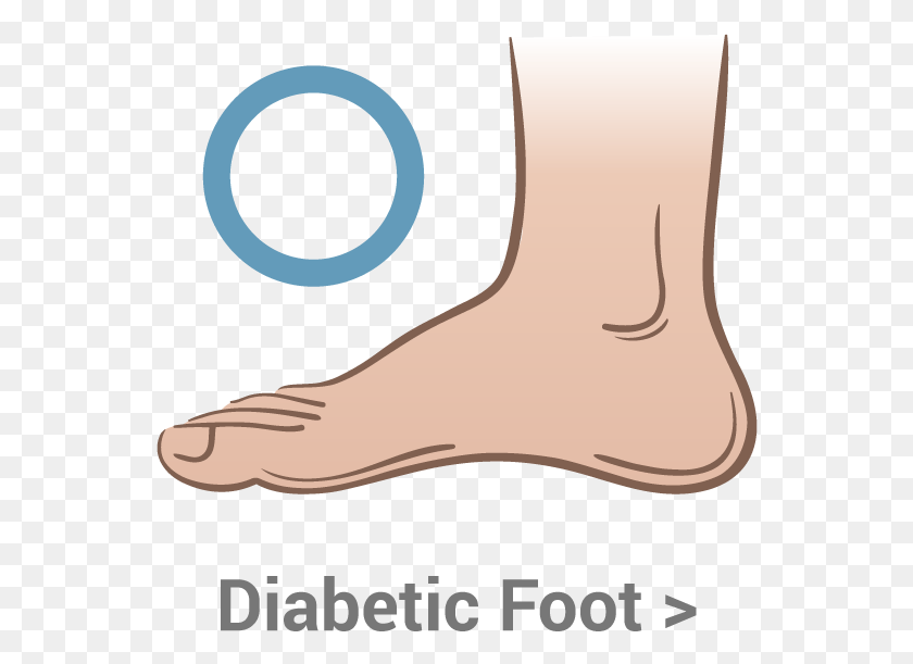 554x551 Diabetic Foot Poor Circulation Foot, Ankle, Heel HD PNG Download