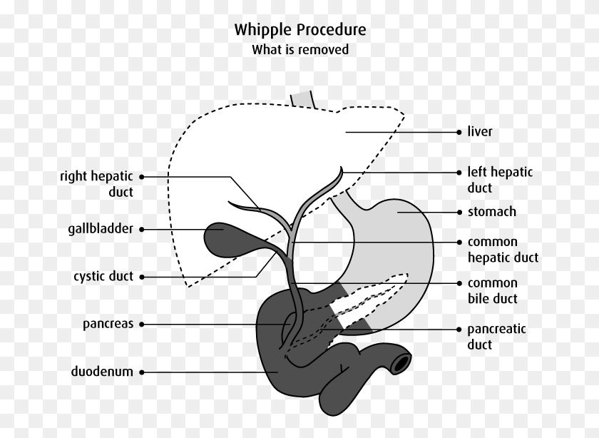671x554 Diagram Of What Is Removed In A Whipple Procedure Pancreas Diagram Black And White, Hand HD PNG Download