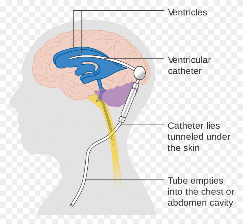 1102x1012 Diagram Showing A Brain Shunt Cruk Ventriculosubgaleal Shunt, Head, Neck, Plot HD PNG Download