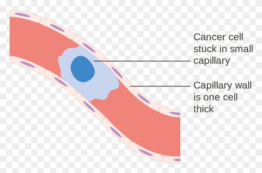 1184x754 Diagram Showing A Cancer Cell Stuck In A Small Blood Diagram Of Blood Cancer, Mouth, Lip HD PNG Download