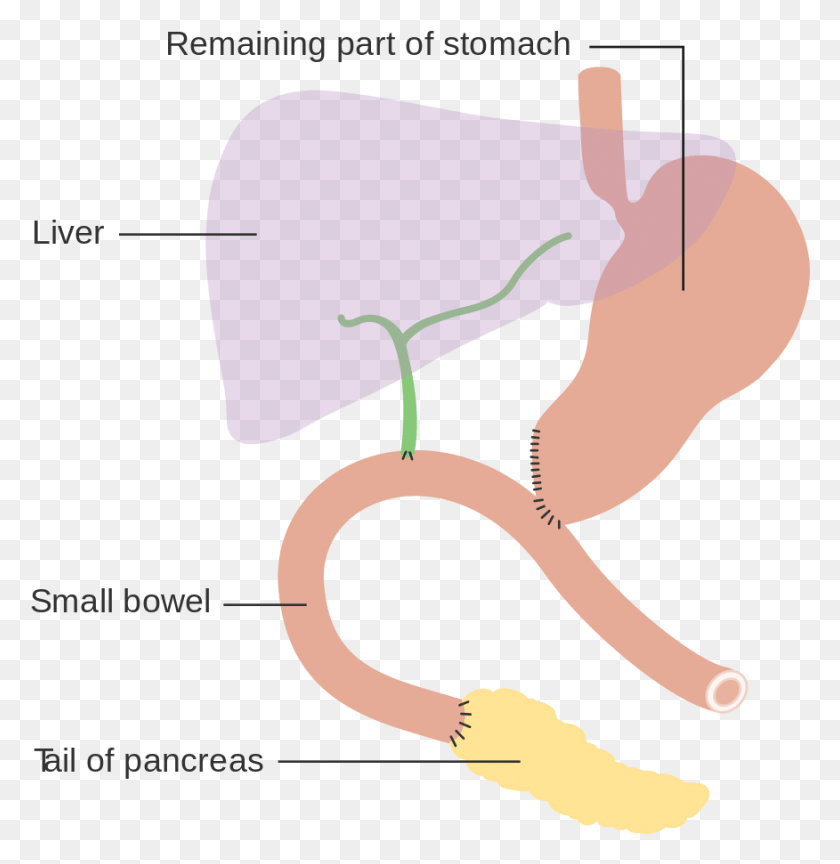 876x903 Diagram Showing How The Pancreas And Bowel Is Joined Traverso Longmire Operation HD PNG Download